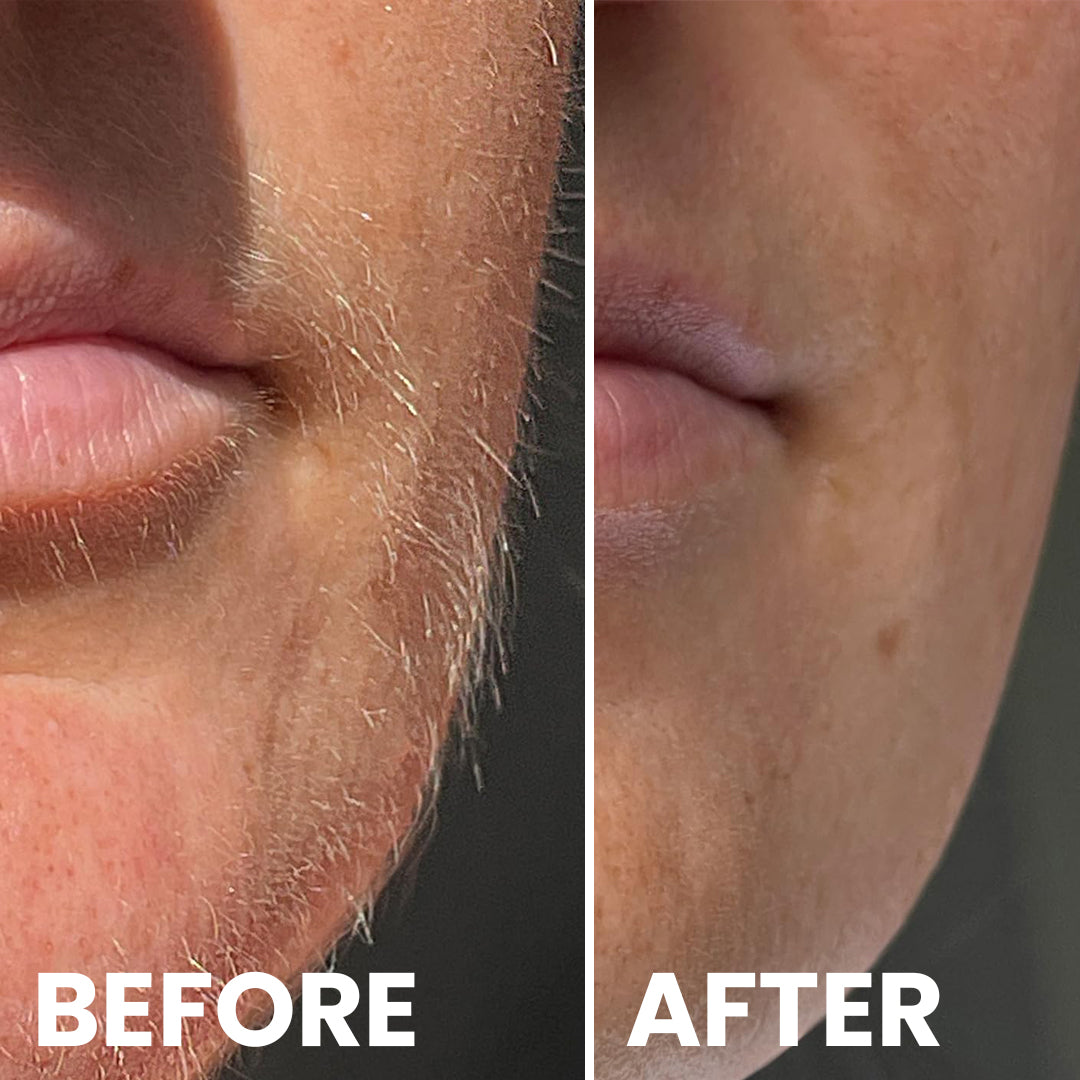 5MINSKIN AT-HOME LASER HAIR REMOVAL HANDSET - 72% OFF CHRISTMAS SALE + 4 FREE GIFTS (WORTH $290)