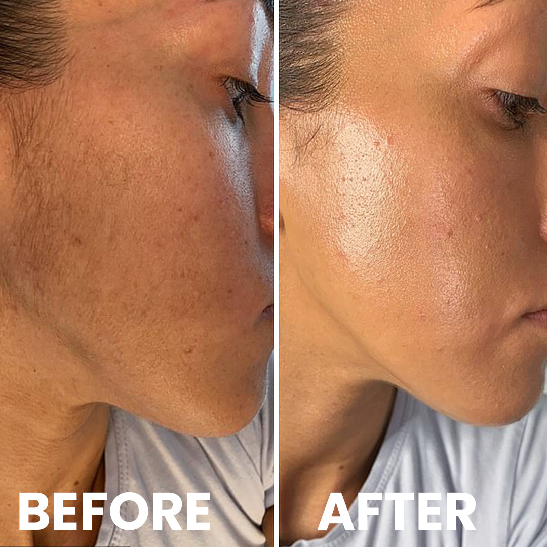 5MINSKIN AT-HOME LASER HAIR REMOVAL HANDSET - 72% OFF CHRISTMAS SALE + 4 FREE GIFTS (WORTH $290)