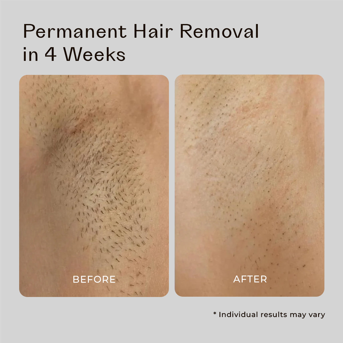 5MINSKIN AT-HOME LASER HAIR REMOVAL HANDSET - 50% OFF CHRISTMAS SALE