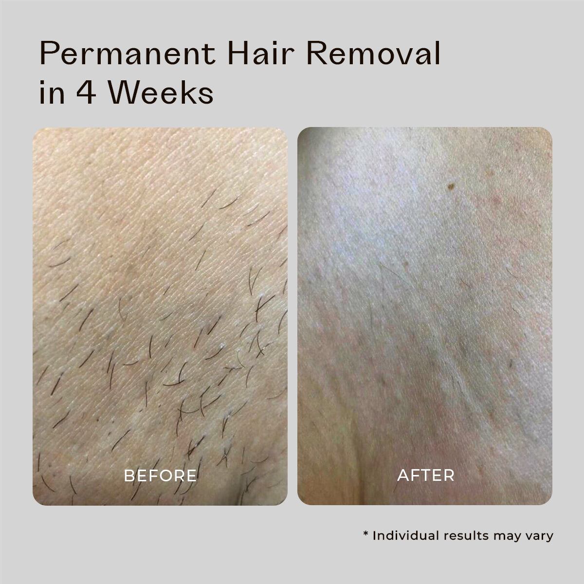 5MINSKIN AT-HOME LASER HAIR REMOVAL HANDSET - 50% OFF CHRISTMAS SALE